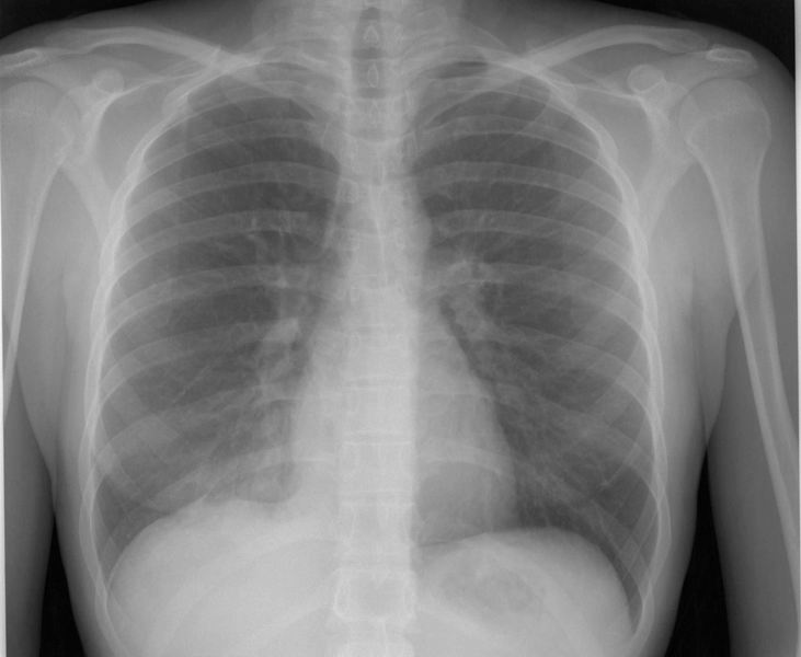 

<a href= "https://rx.alain-dens.com/wp-content/uploads/2024/11/Thorax_f.jpg"